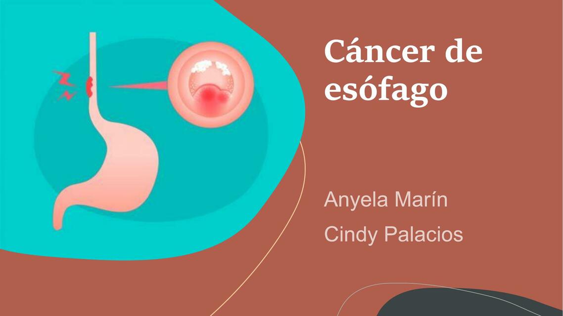 Cáncer de Esófago