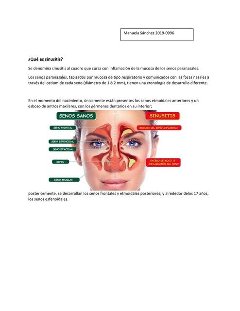 ¿Qué es Sinusitis?