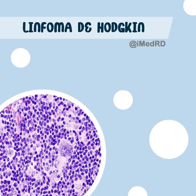 Linfoma de Hodgkin