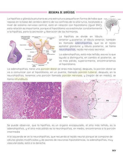 Adenoma de Hipófisis 