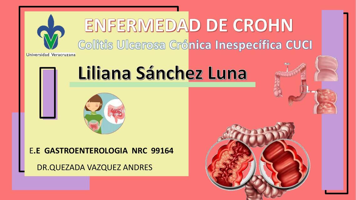 Enfermedad de Crohn 