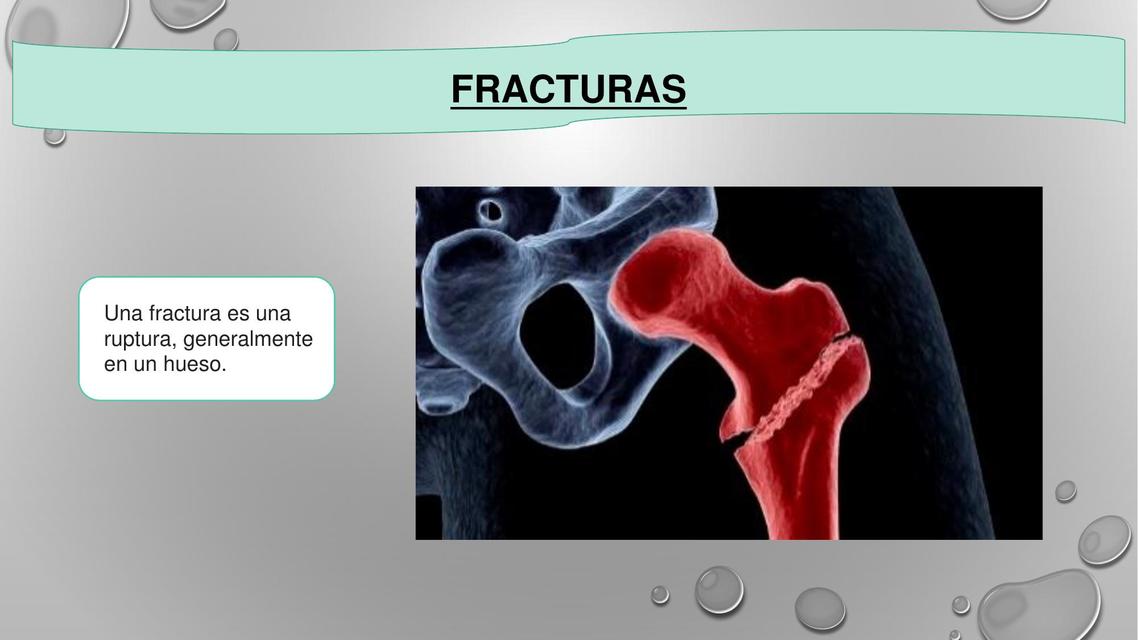 Fracturas