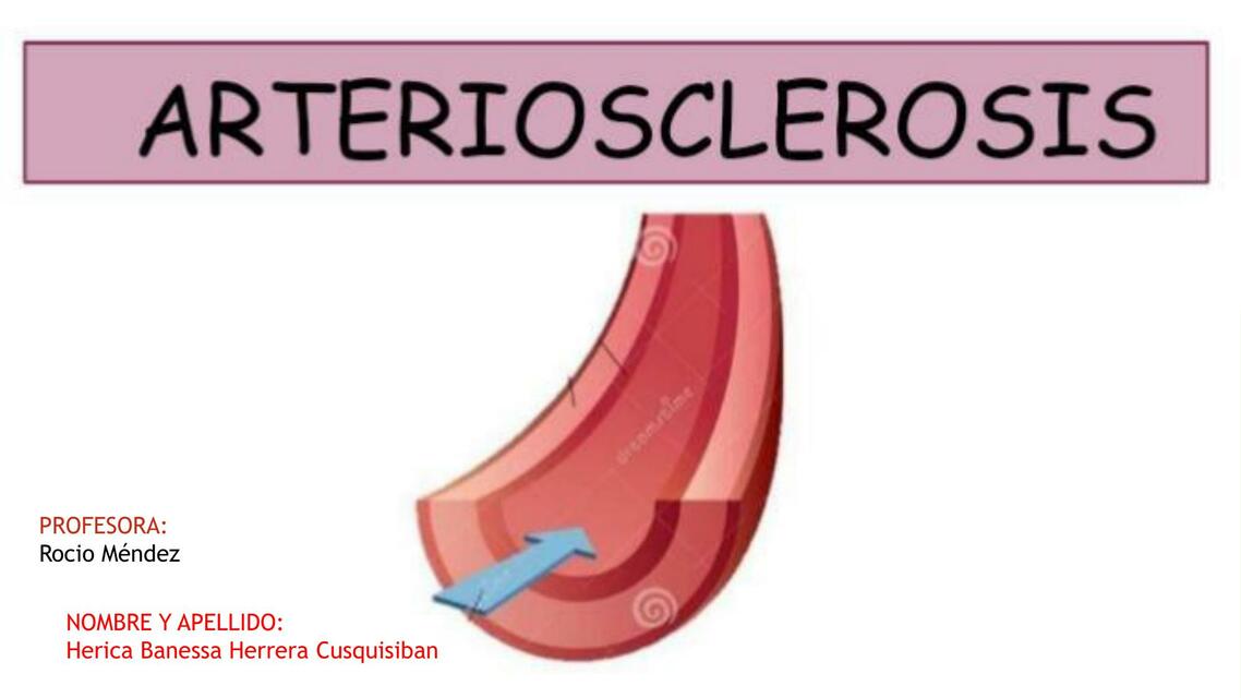 Arteriosclerosis 