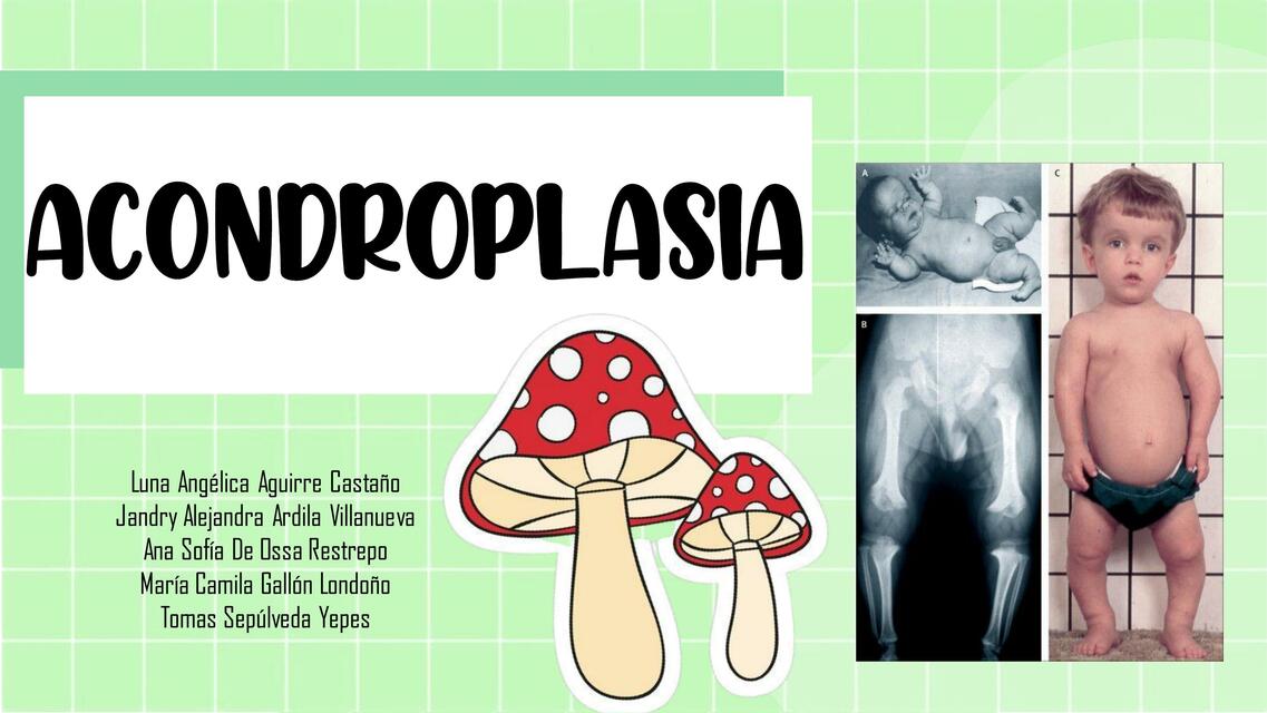 Acondroplasia