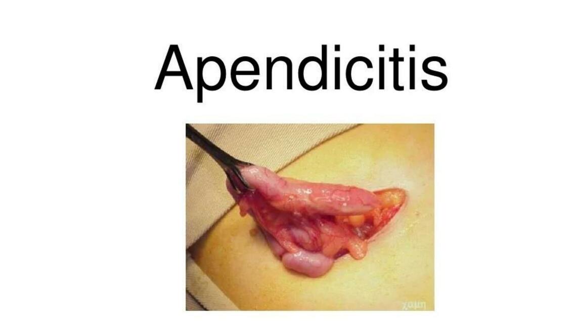 Apendicitis