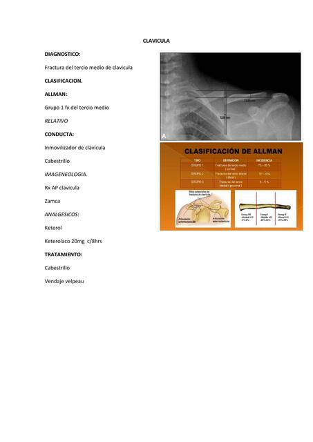 Fractura de Clavícula 