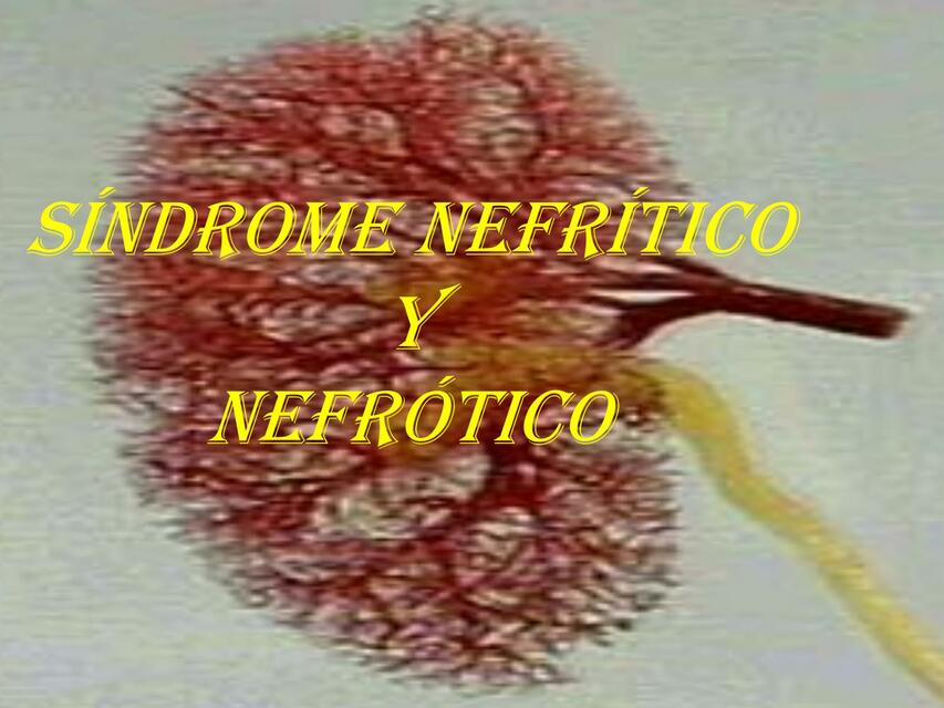 Síndrome Nefrítico y Nefrótico