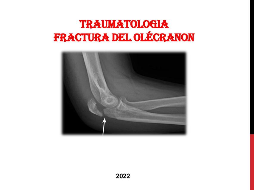 Fractura del Olécranon