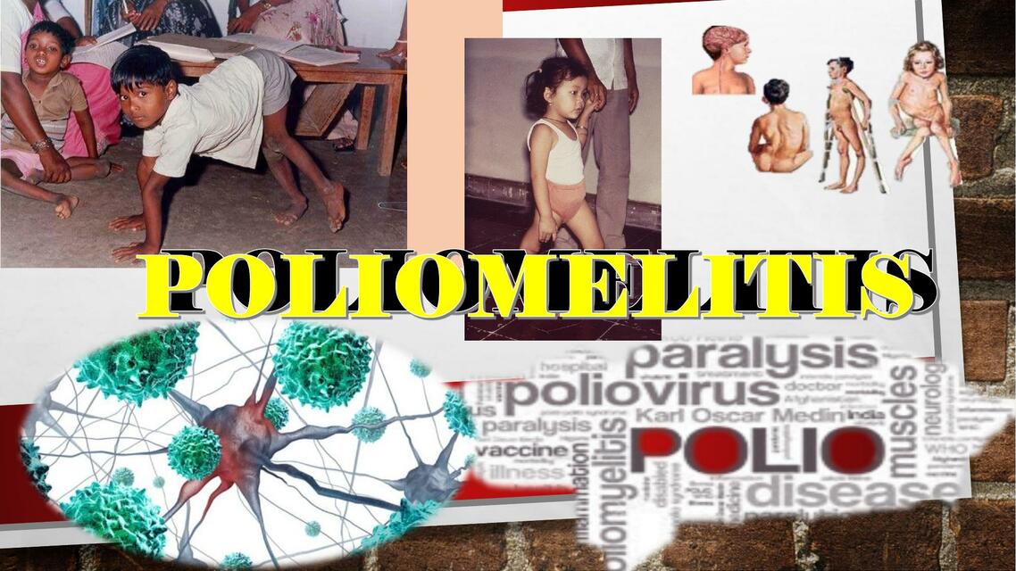 Poliomelitis 