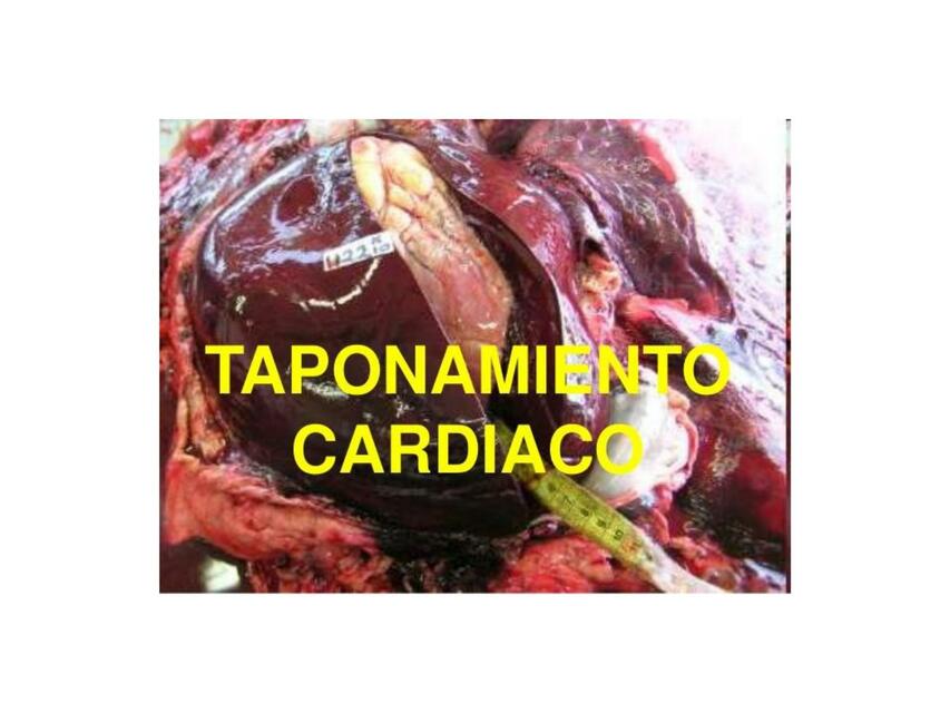 Taponamiento Cardiaco 