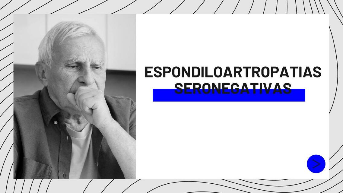 Espondiloartropatías Seronegativas