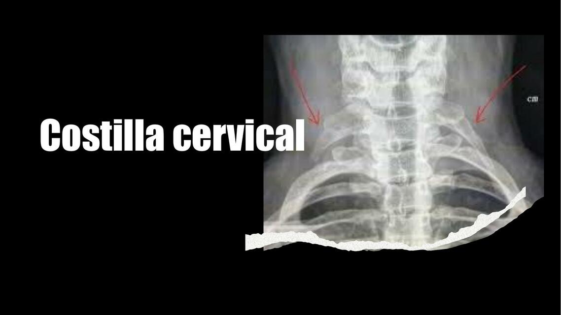 Costilla Cervical 