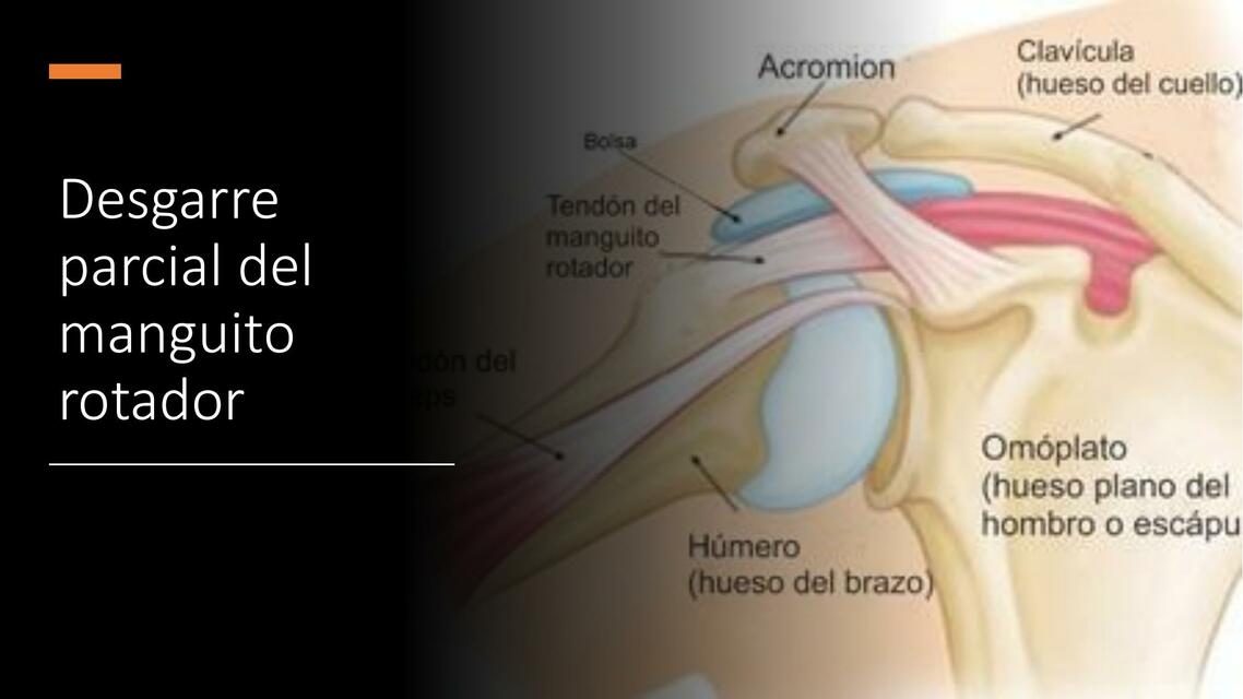 Desgarre Parcial del Manguito Rotador