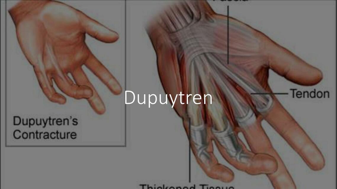 Dupuytren