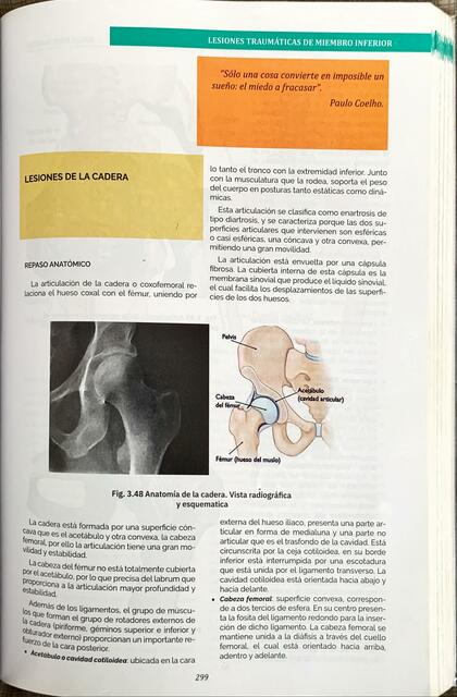 Fx Fémur Proximal