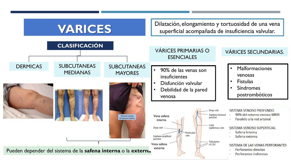 Varices 