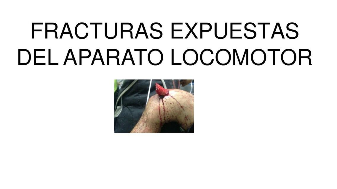 Fracturas Expuestas del Aparato Locomotor 