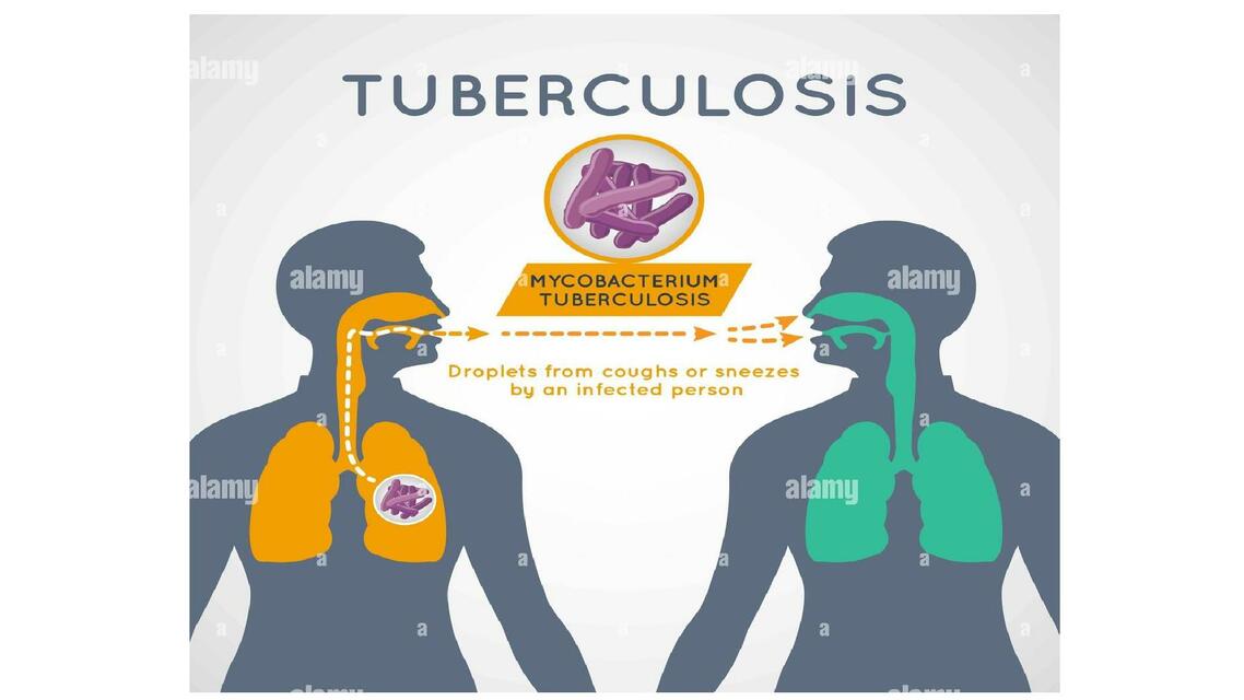 Tuberculosis 