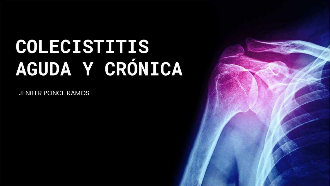 Colecistitis Aguda y Crónica 