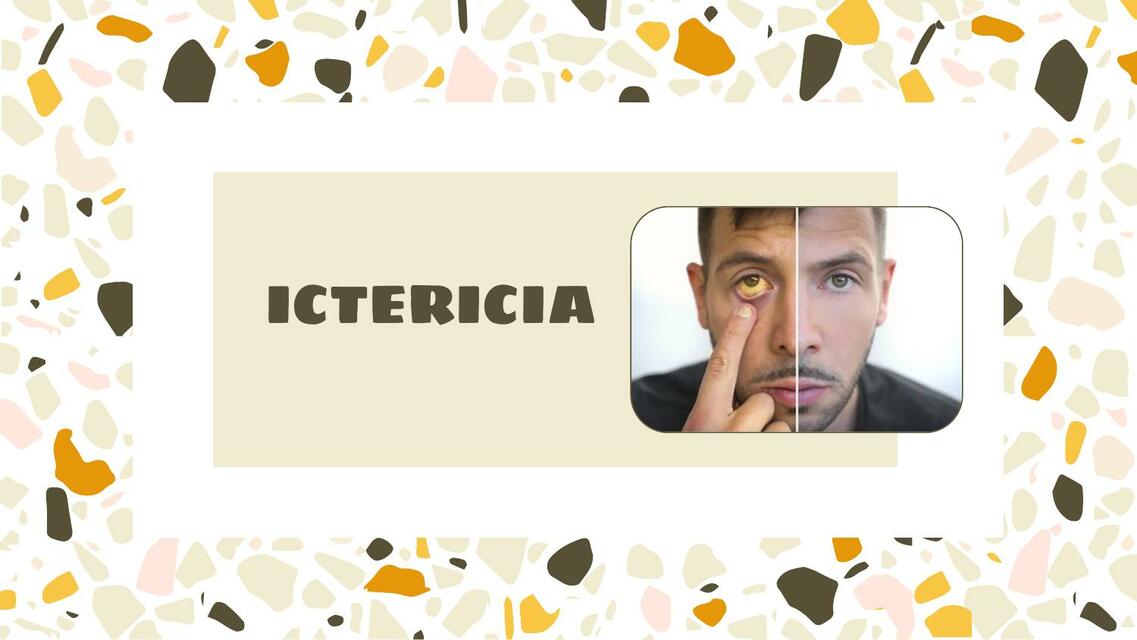 Ictericia 