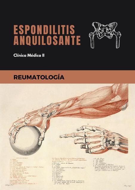 Espondilitis Anquilosante