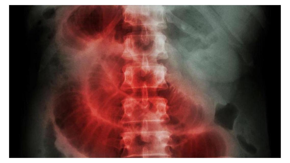 Síndrome de Obstrucción Intestinal 