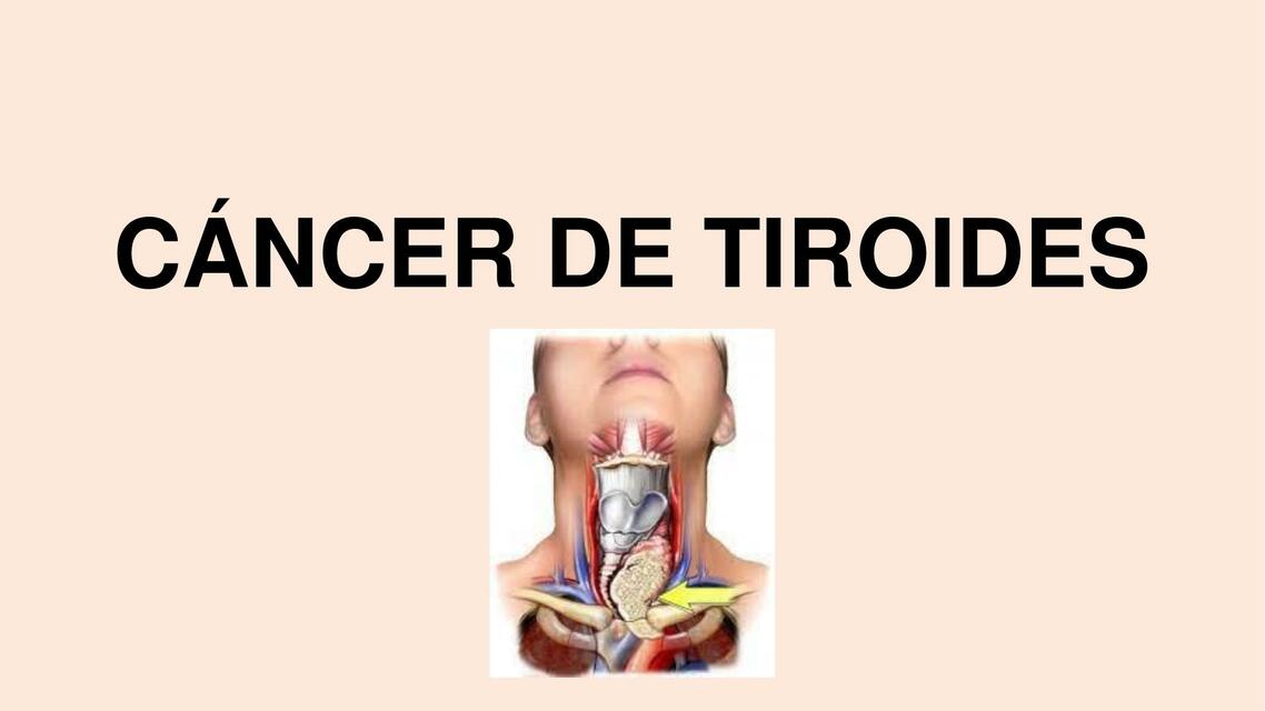 Cáncer de Tiroides