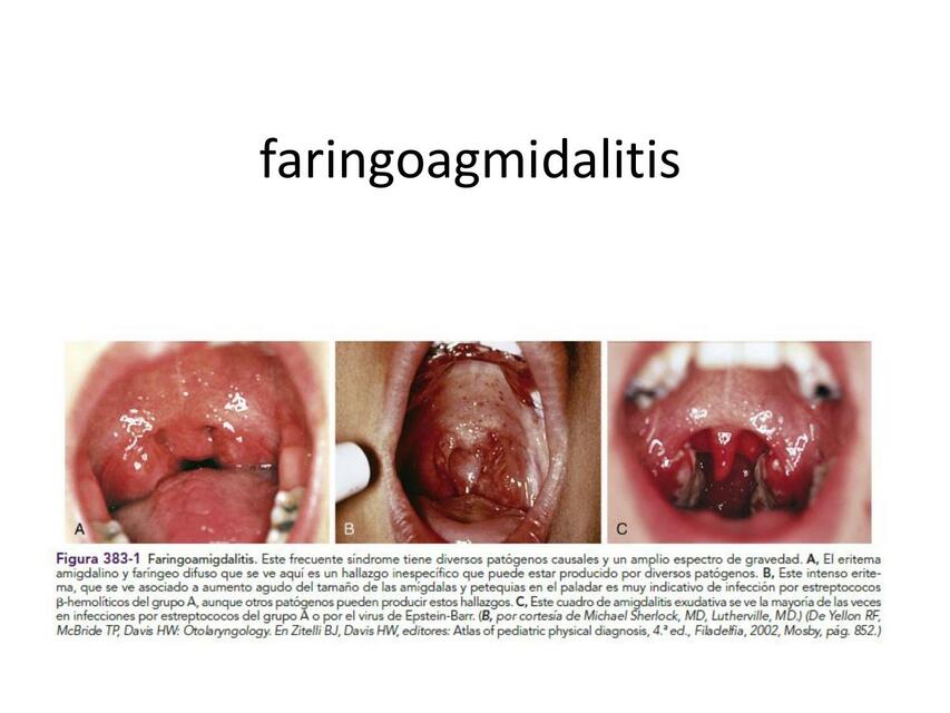 Faringoamigdalitis y fiebre reumática 