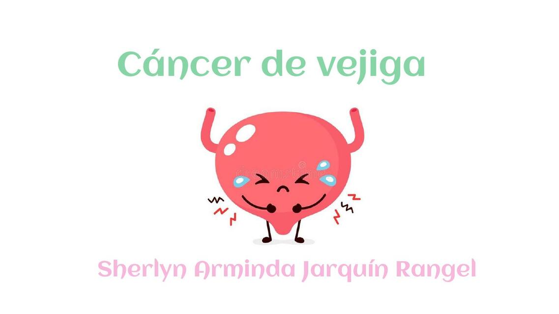 Cáncer de Vejiga 