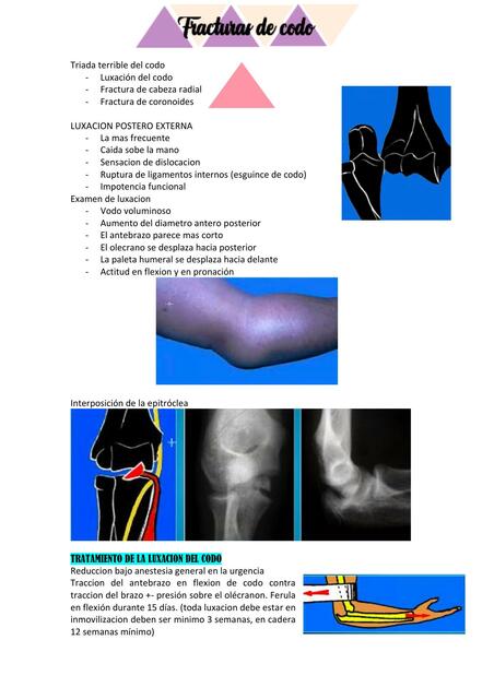 Fracturas de Codo 