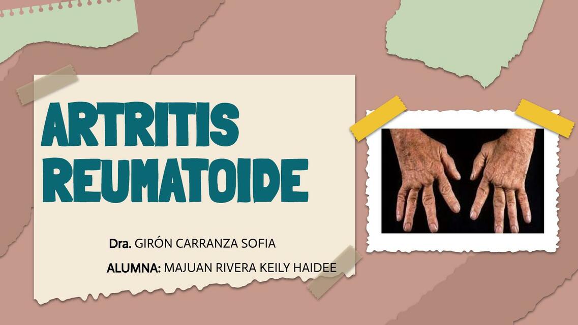 Artritis Reumatoide