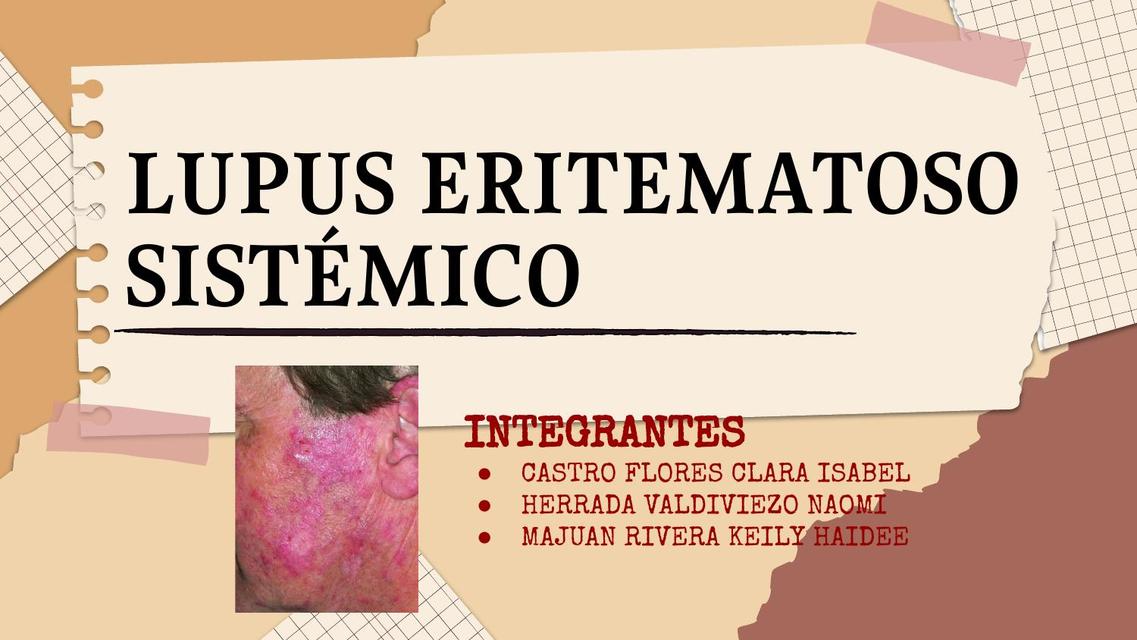 Lupus Eritematoso Sistémico