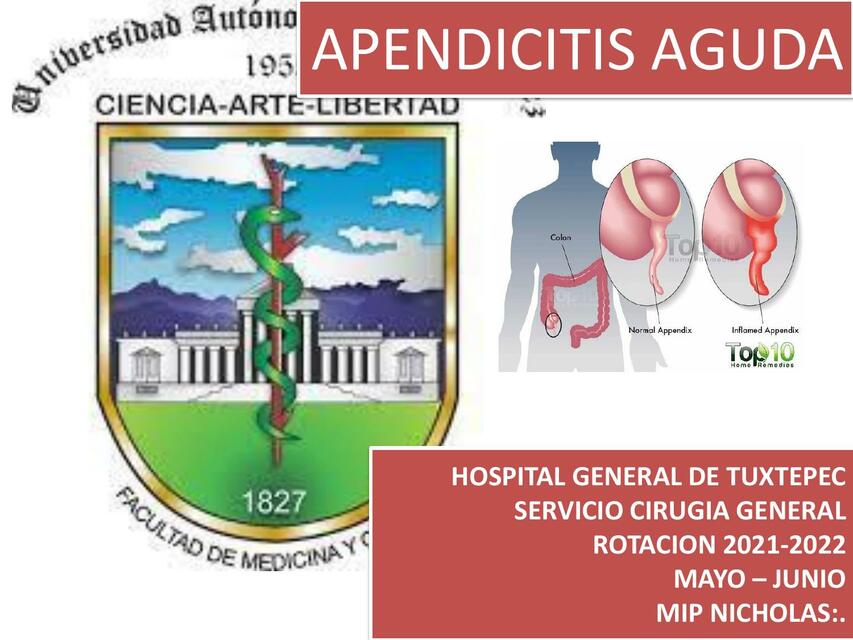 Apendicitis Aguda