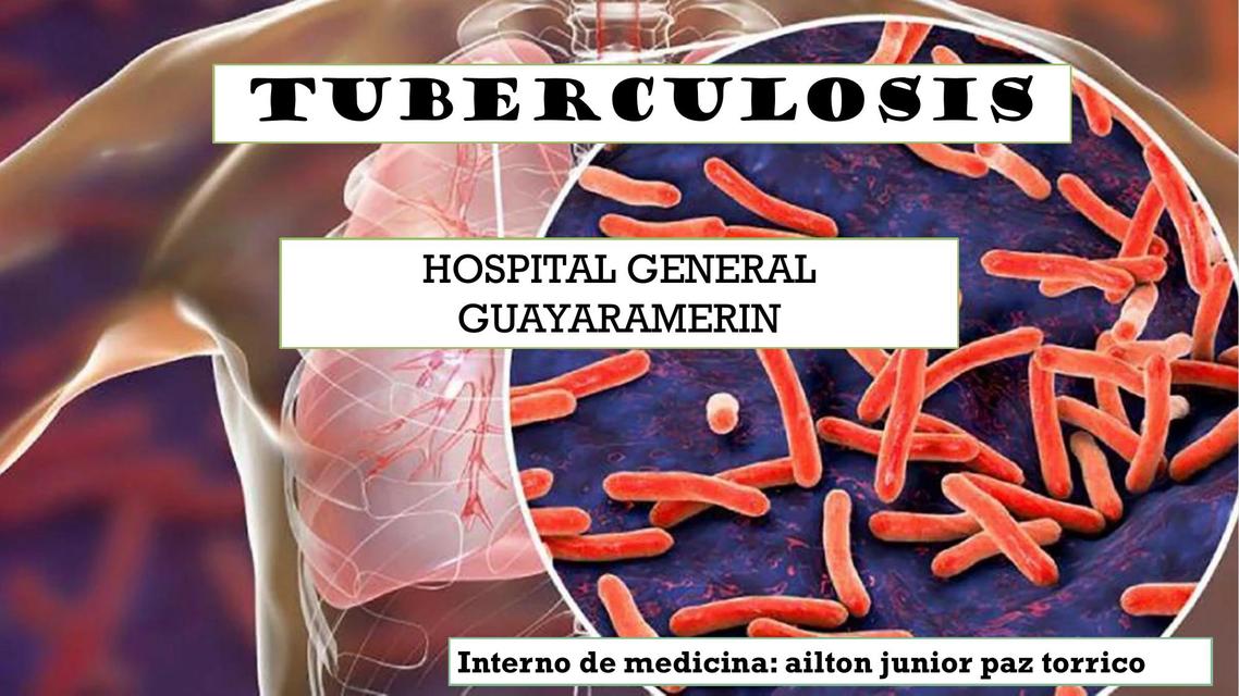 Tuberculosis 