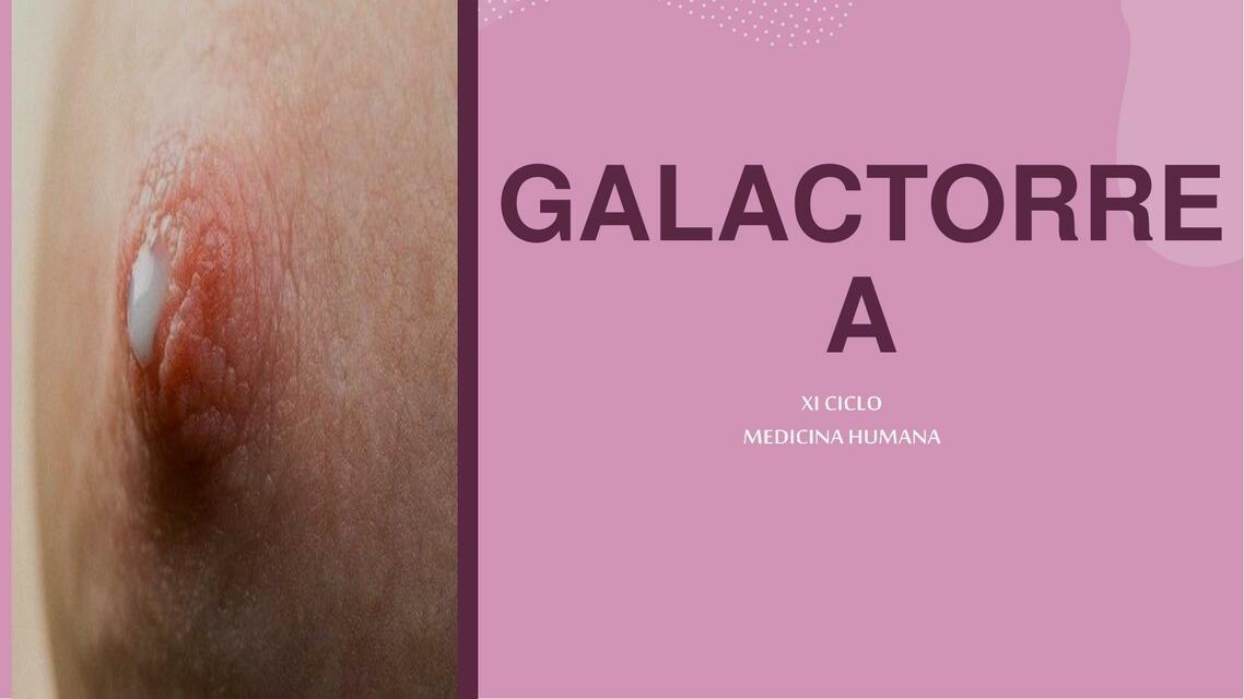 Galactorrea 