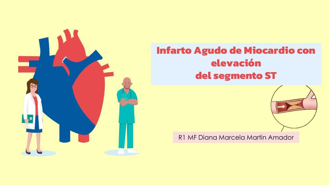 Infarto Agudo de Miocardio con elevación del segmento ST