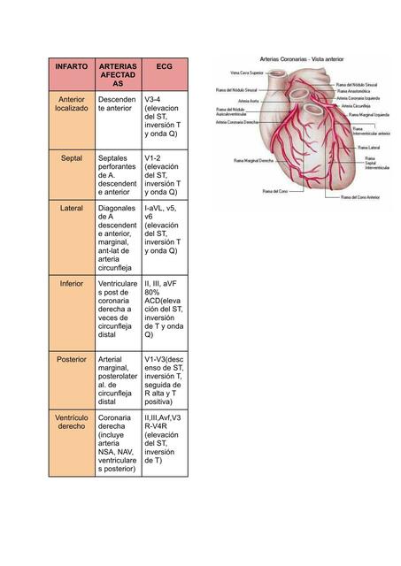 Arterias implicadas en infarto