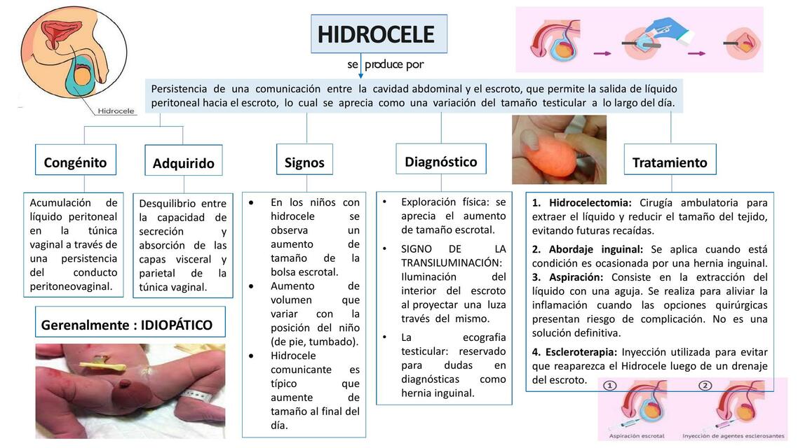 Hidrocele