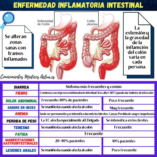 Enfermedad Inflamatoria Intestinal