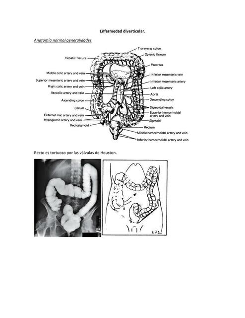 Enfermedad Diverticular