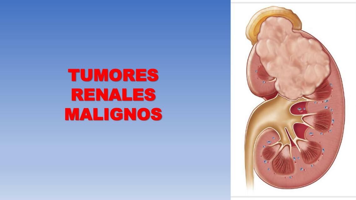 TUMORES RENALES MALIGNOS