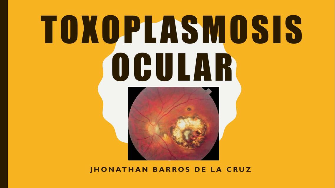 Toxoplasmosis Ocular