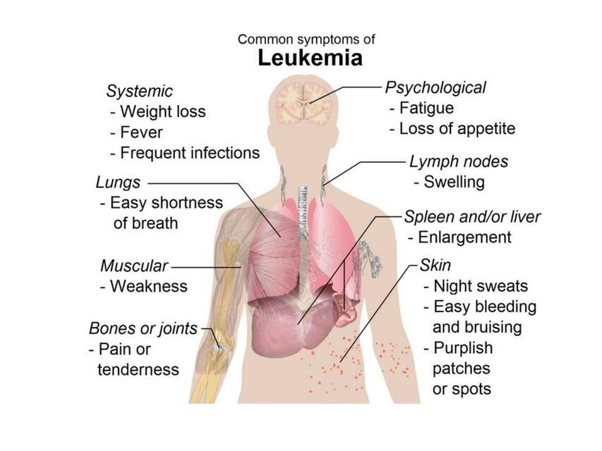 Common Symptoms of Leukemia 