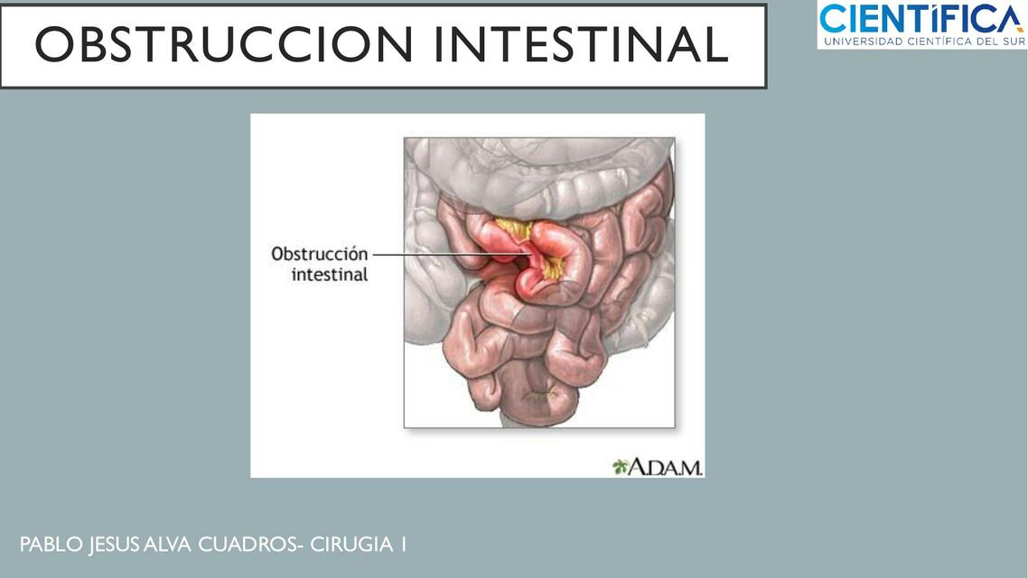 Obstrucción intestinal