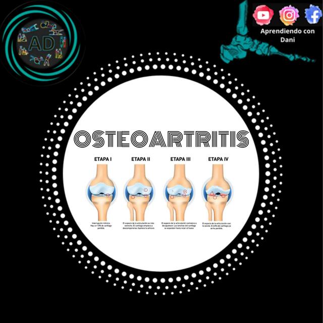 Osteoartritis 