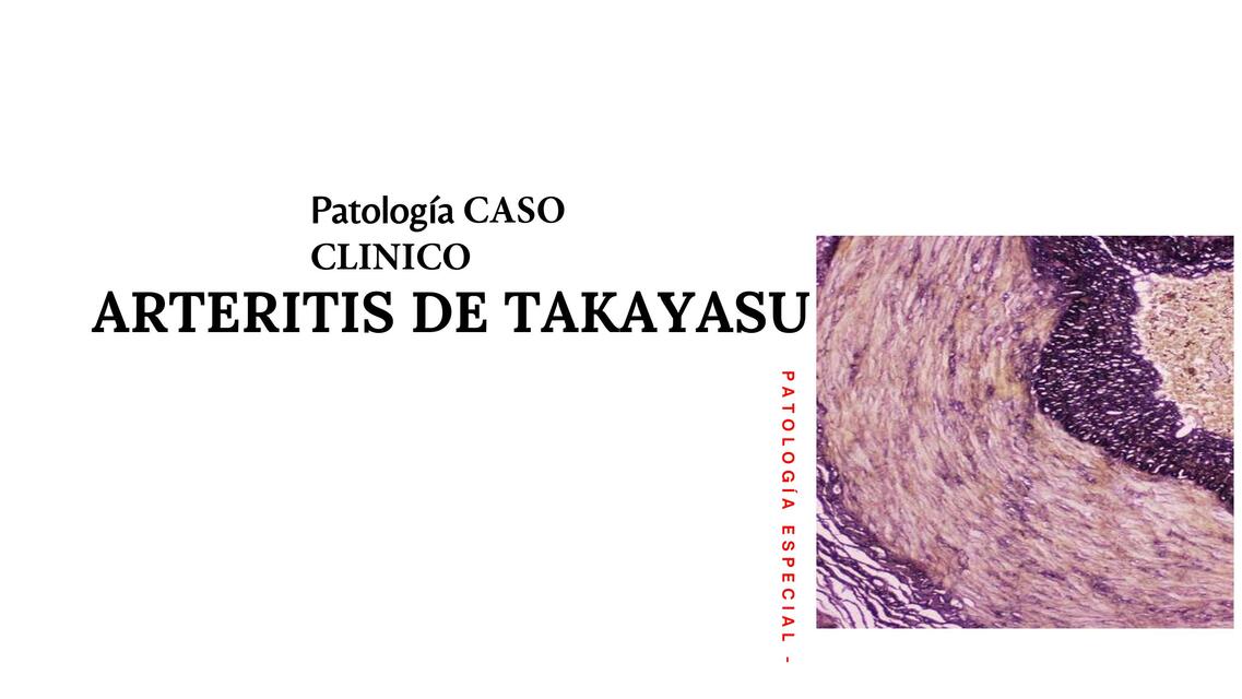 Patología caso clínico Arteritis de takayasu