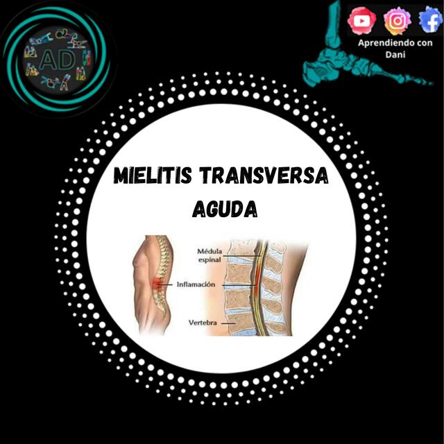 Mielitis transversa aguda 