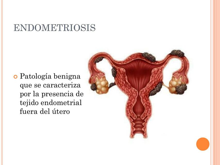 Endometriosis 