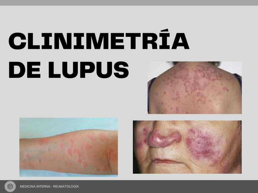 Clinimetría de Lupus