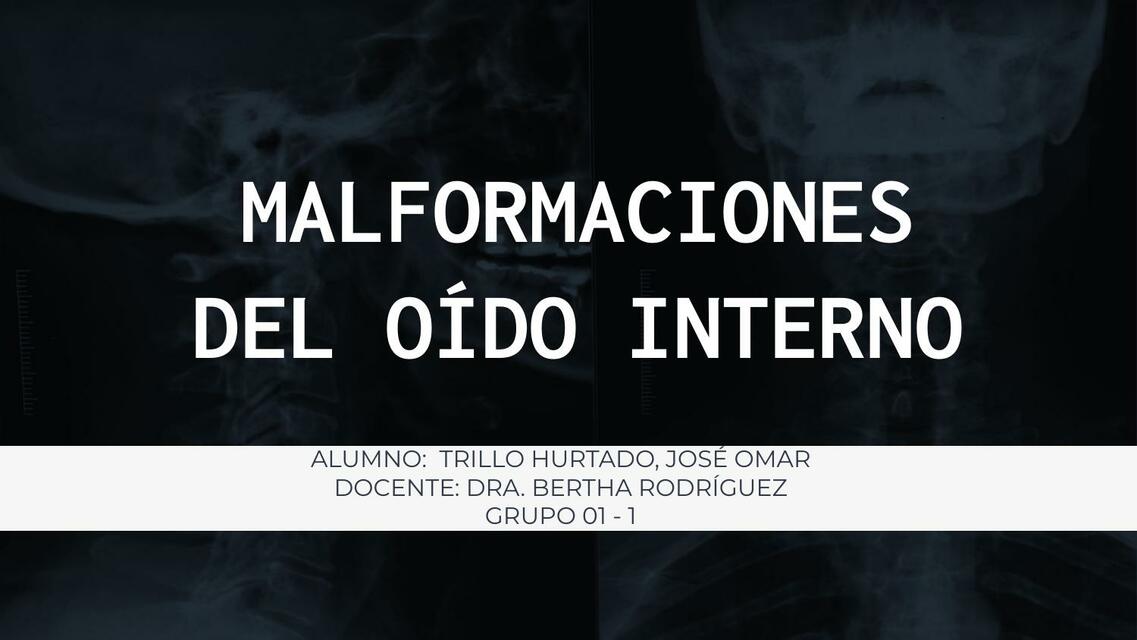 Malformaciones del oído interno